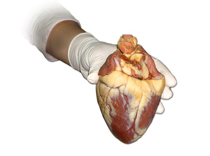 Světový den srdce: Kardiovaskulární choroby u nás stále nejčastější příčinou úmrtí