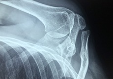 KB Pojišťovna: Jaké jsou důvody výplaty z pojištění storna?